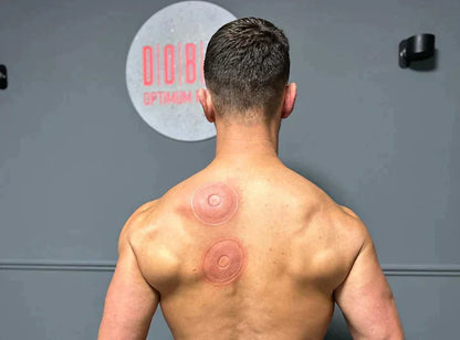 SmartCup Electric Cupping